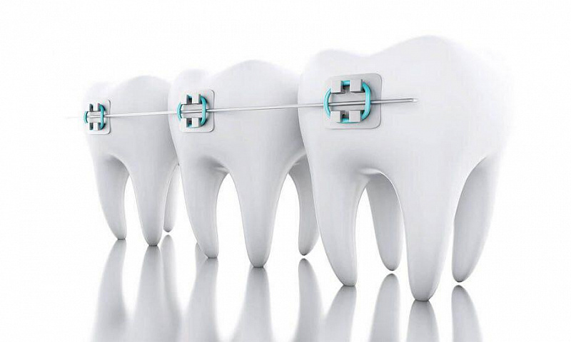 Виды ортодонтических систем для исправления прикуса у детей и подростков