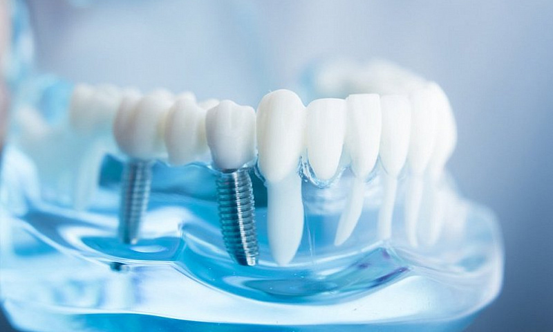 Риск повреждения нерва при имплантации зубов
