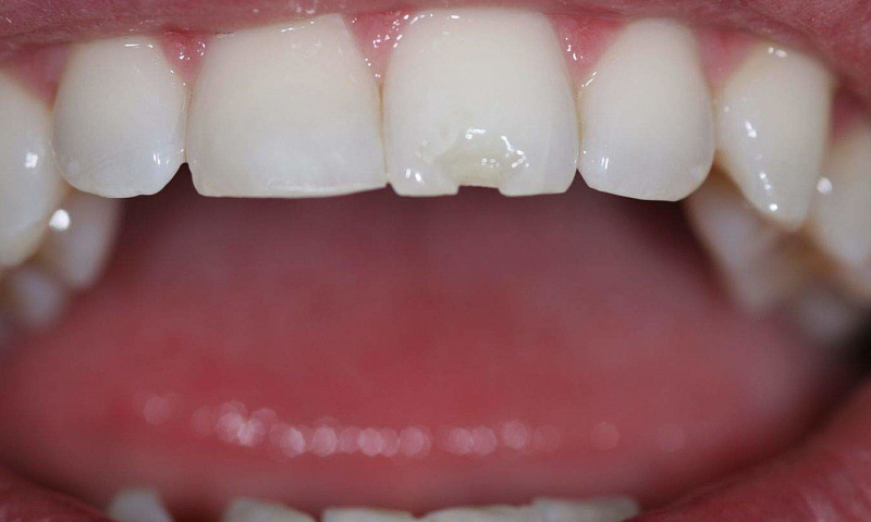 Скол зуба у ребенка: первая помощь, методы лечения