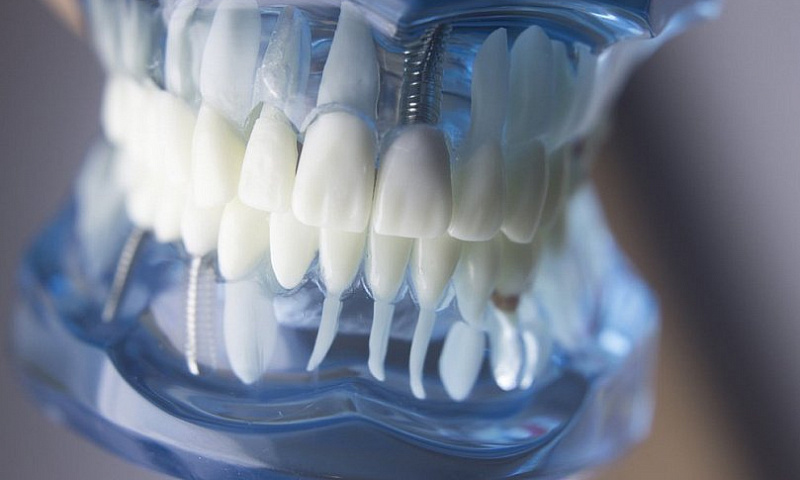 Риски при имплантации зубов: мифы и реальность