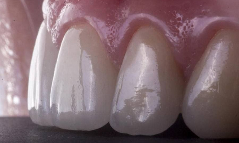 Методика удлинения коронки зуба