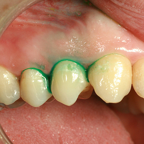 Фотодинамическая и фототермическая терапия в стоматологии
