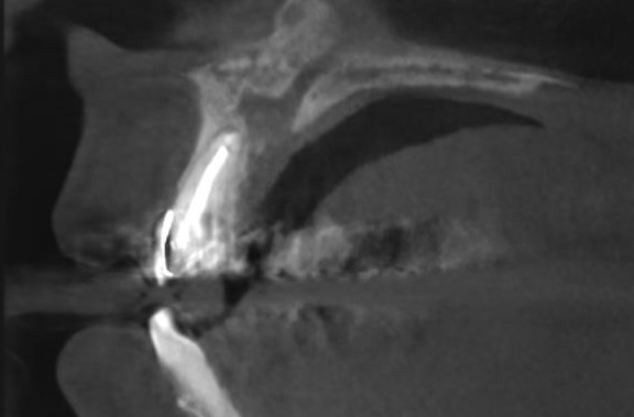 Поперечный срез в области зуба 2.1 - заметно полное закрытие костного дефекта 