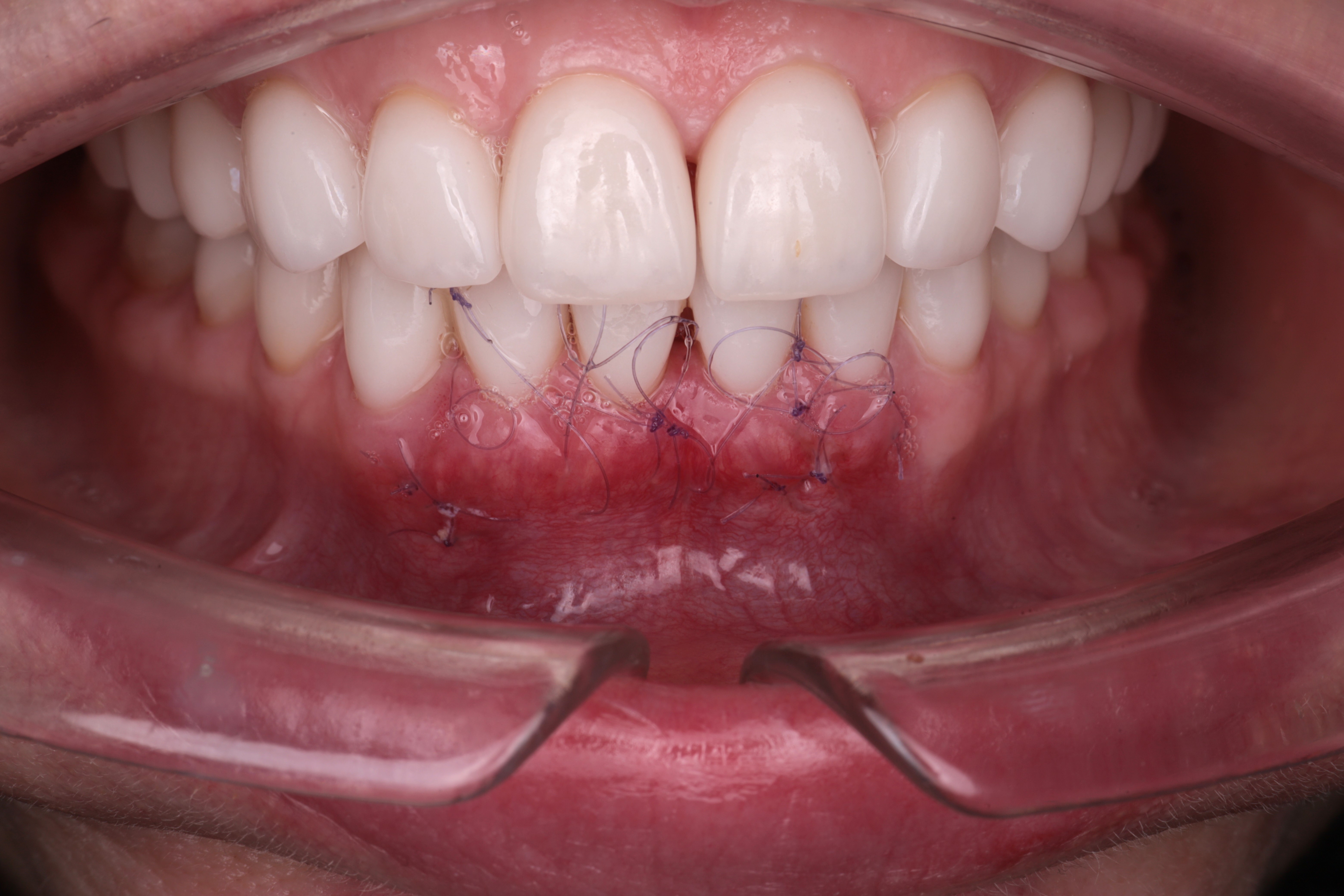 Ситуация через неделю после операции. Швы не состоятельны, рана выглядит удовлетворительно.