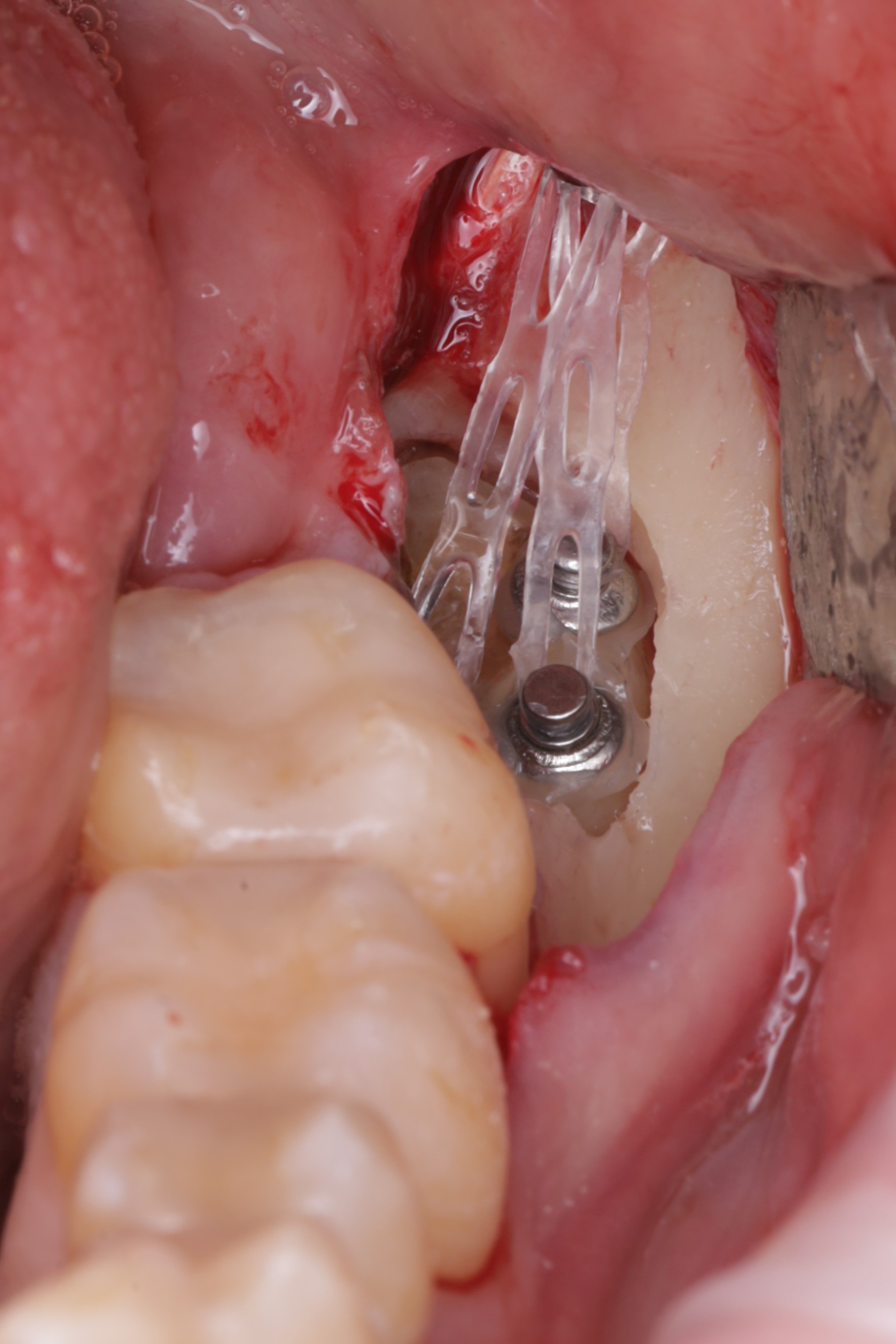 Произвдена активация с помощью ортодонтичечских тяг