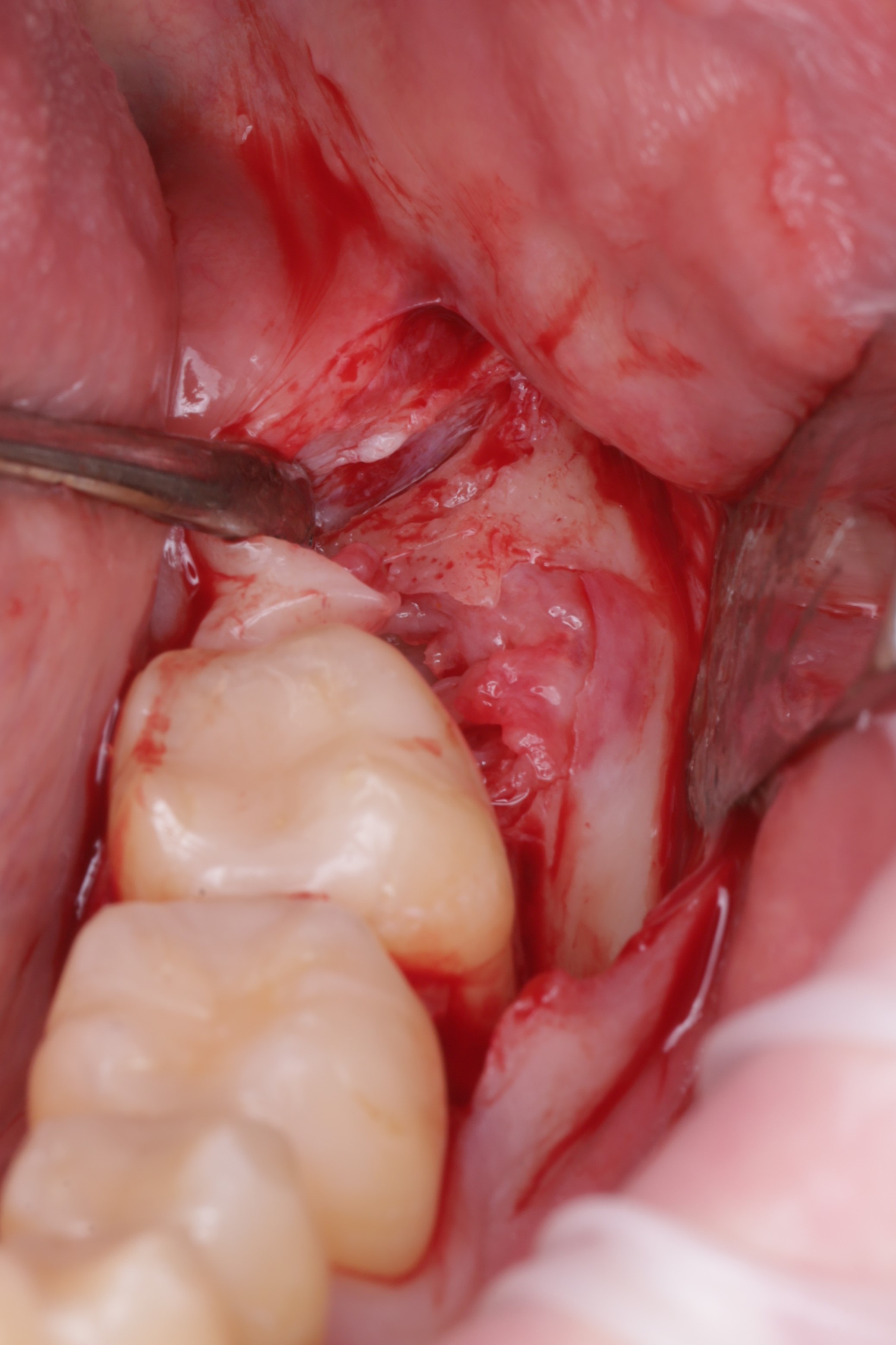 Аккуратно сформирован доступ к ретинированному зубу