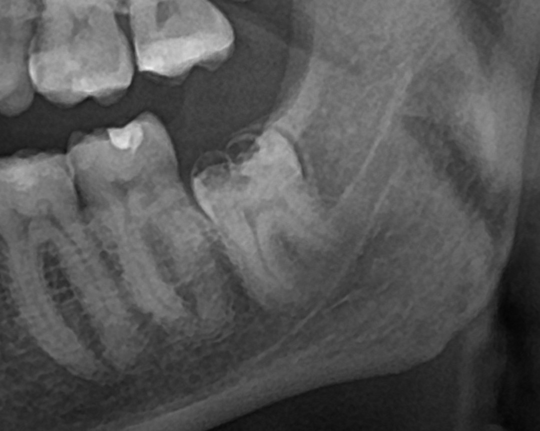 диагностическая ОПТГ