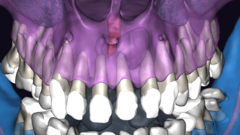 ЗД исследование перед операцией. Виден обьемный дефект в области зубов 21, 22 с вовлечением резцового канала. Размеры 