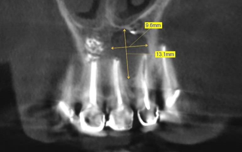 Размеры кисты около1,3 мм в диаметре