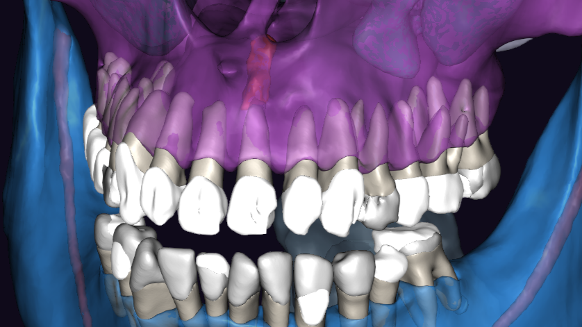 На ЗД реконструкции заметно отсутствие костного дефекта 