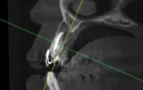Киста в области зуба 2.2