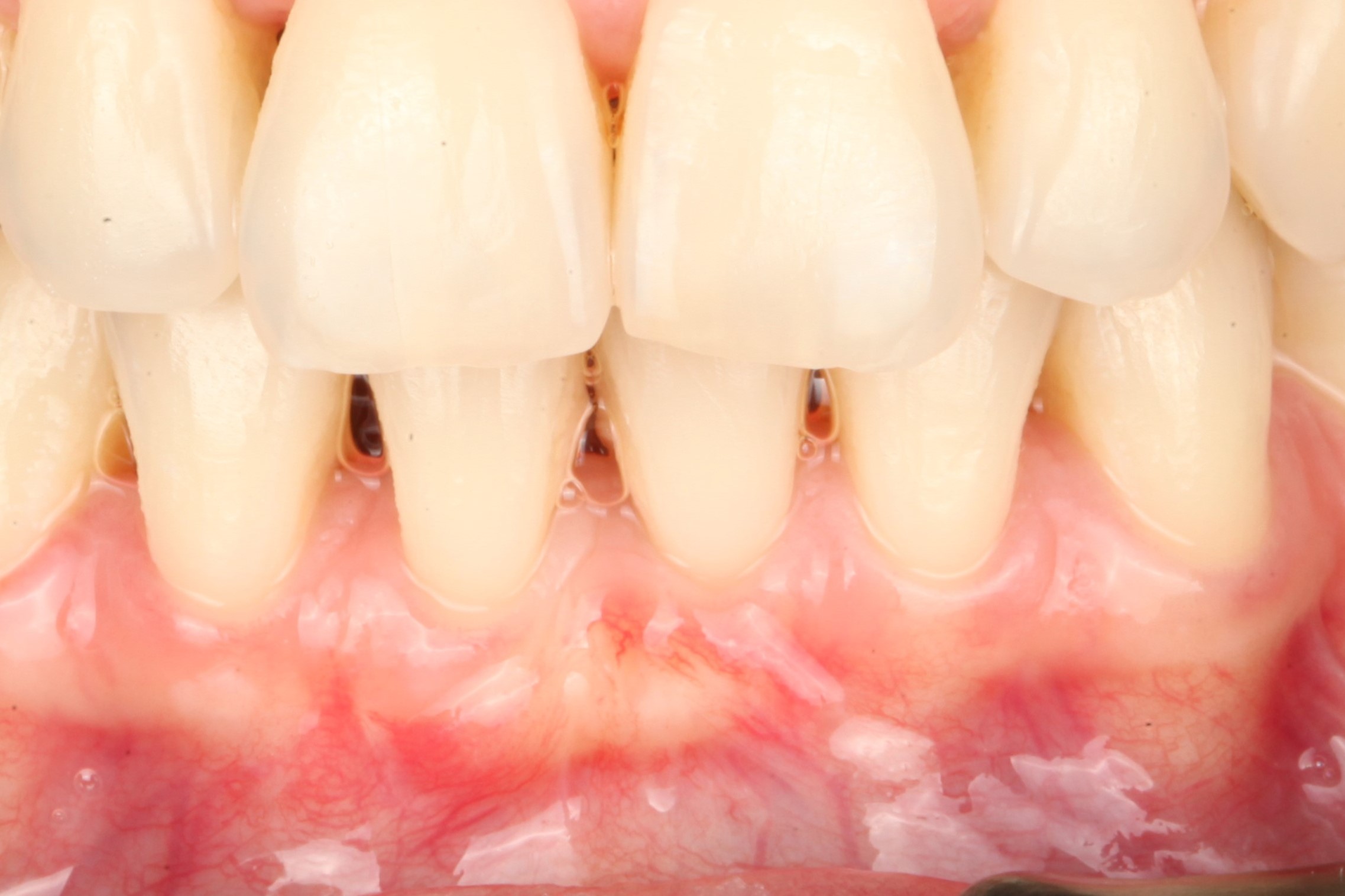 через 4 месяца после операции мы видим явное улучшение клинической картины