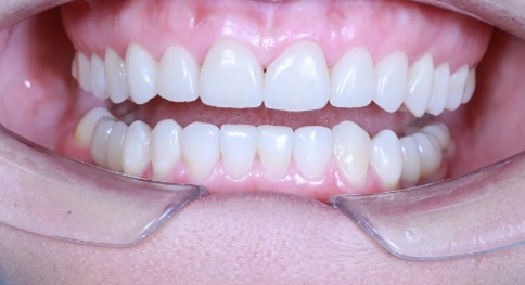 «Ортодонт и хирург: Минивинты и имплантация – командная работа для максимального результата»