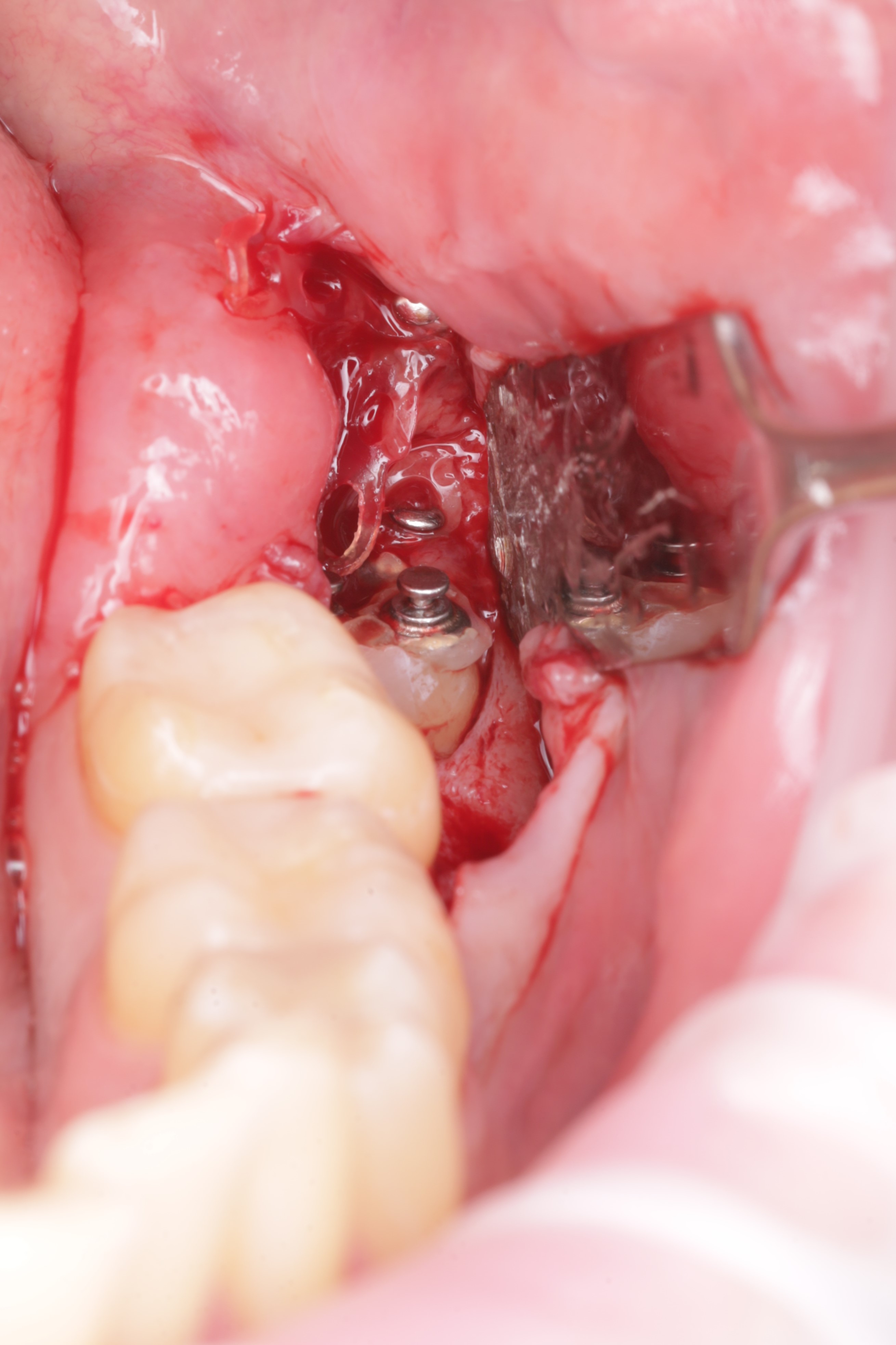 Раскрытие раны и снятие ортодонтических тяг 