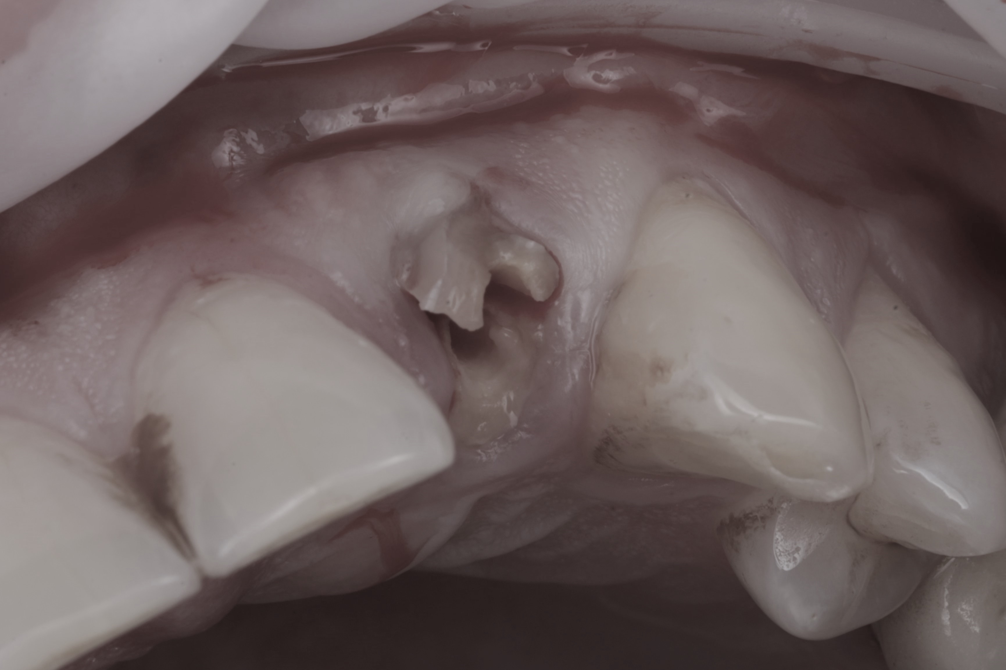 Отломок корня 