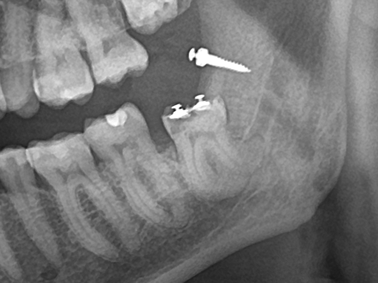ОПТГ на 14 неделе