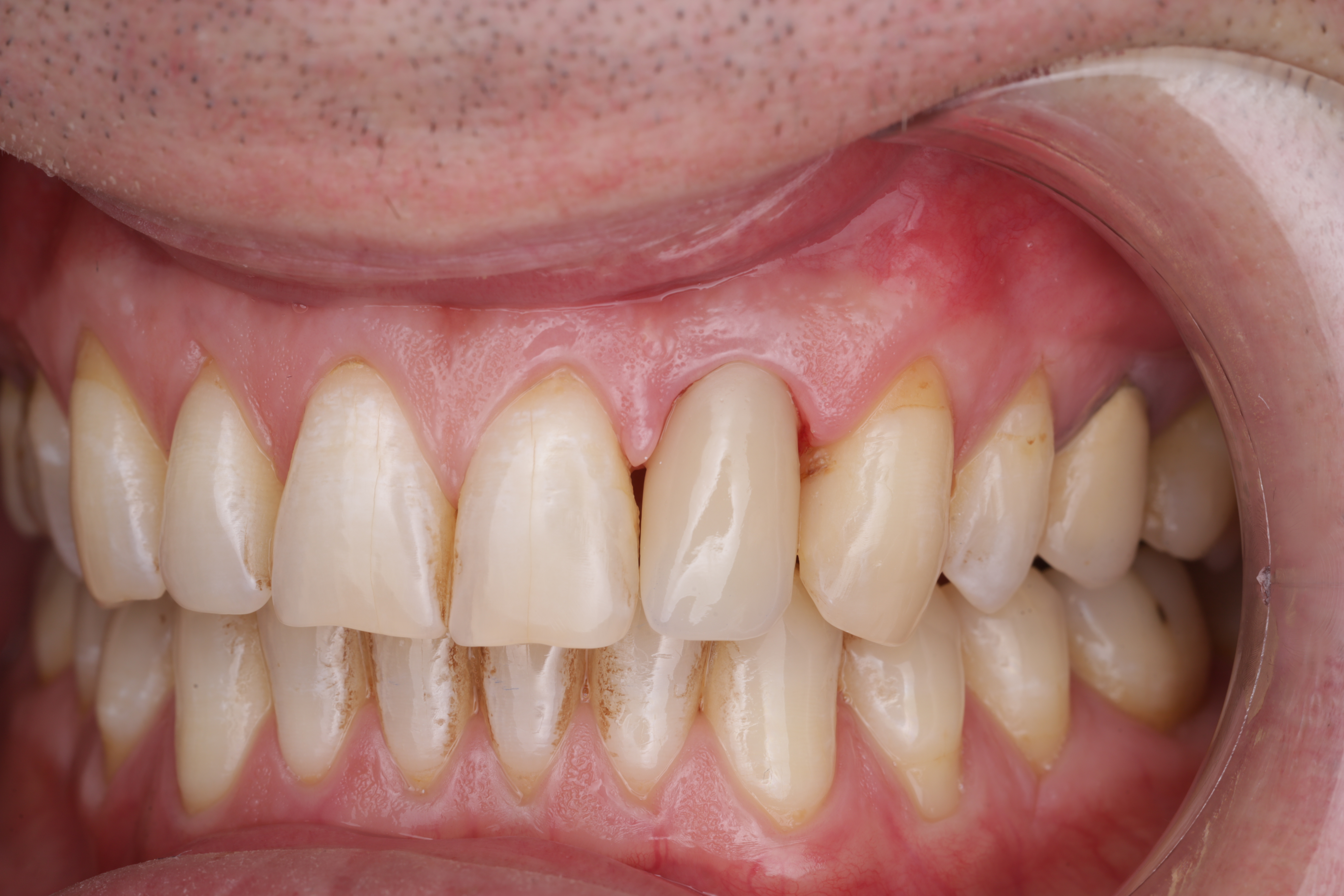 Так выглядит постоянная коронка сразу после фиксации. Десневые сосочки     полностью заполнят пространство между зубами за несколько недель. 