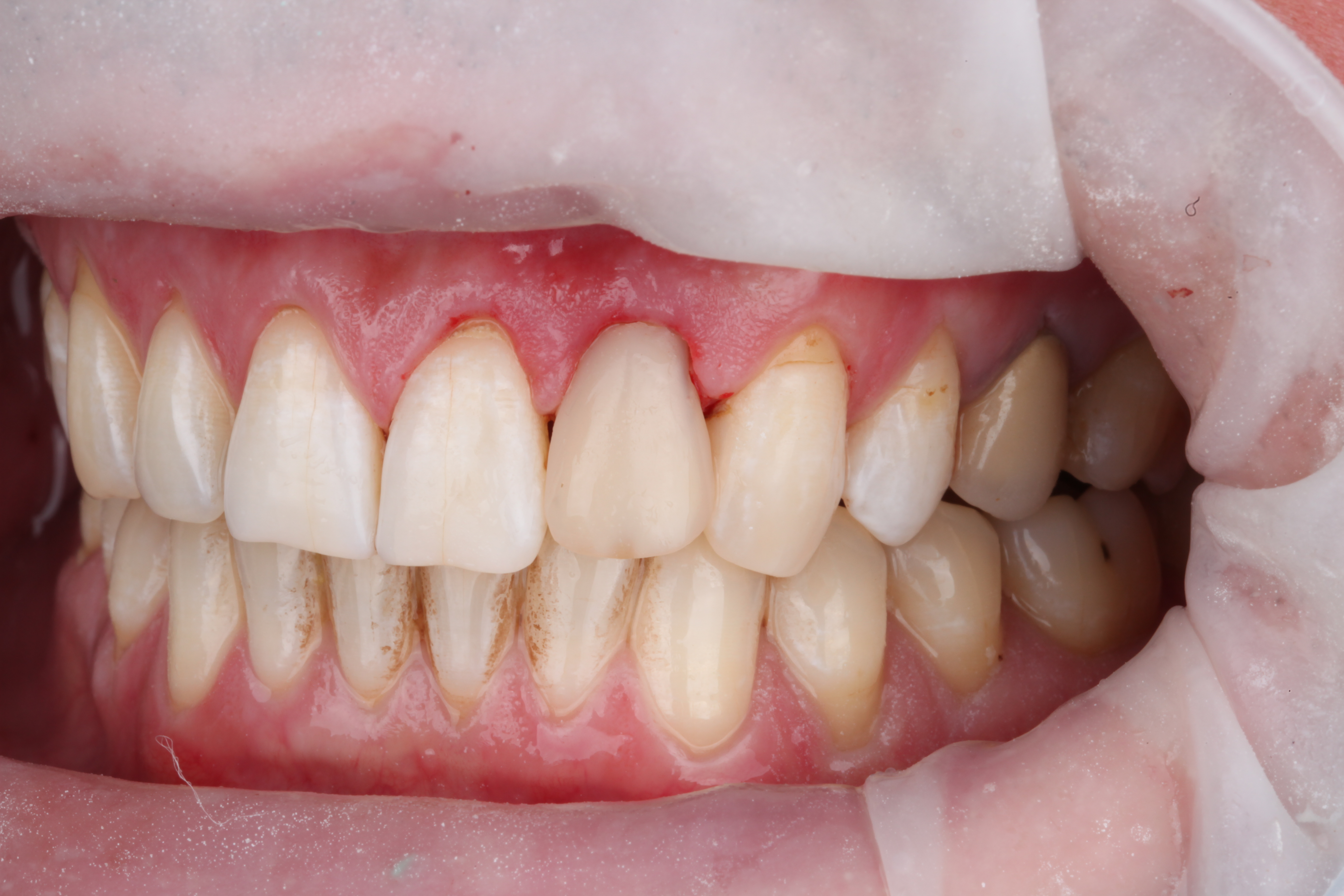 Сделана временная композитная реставрация и установка нового штифта