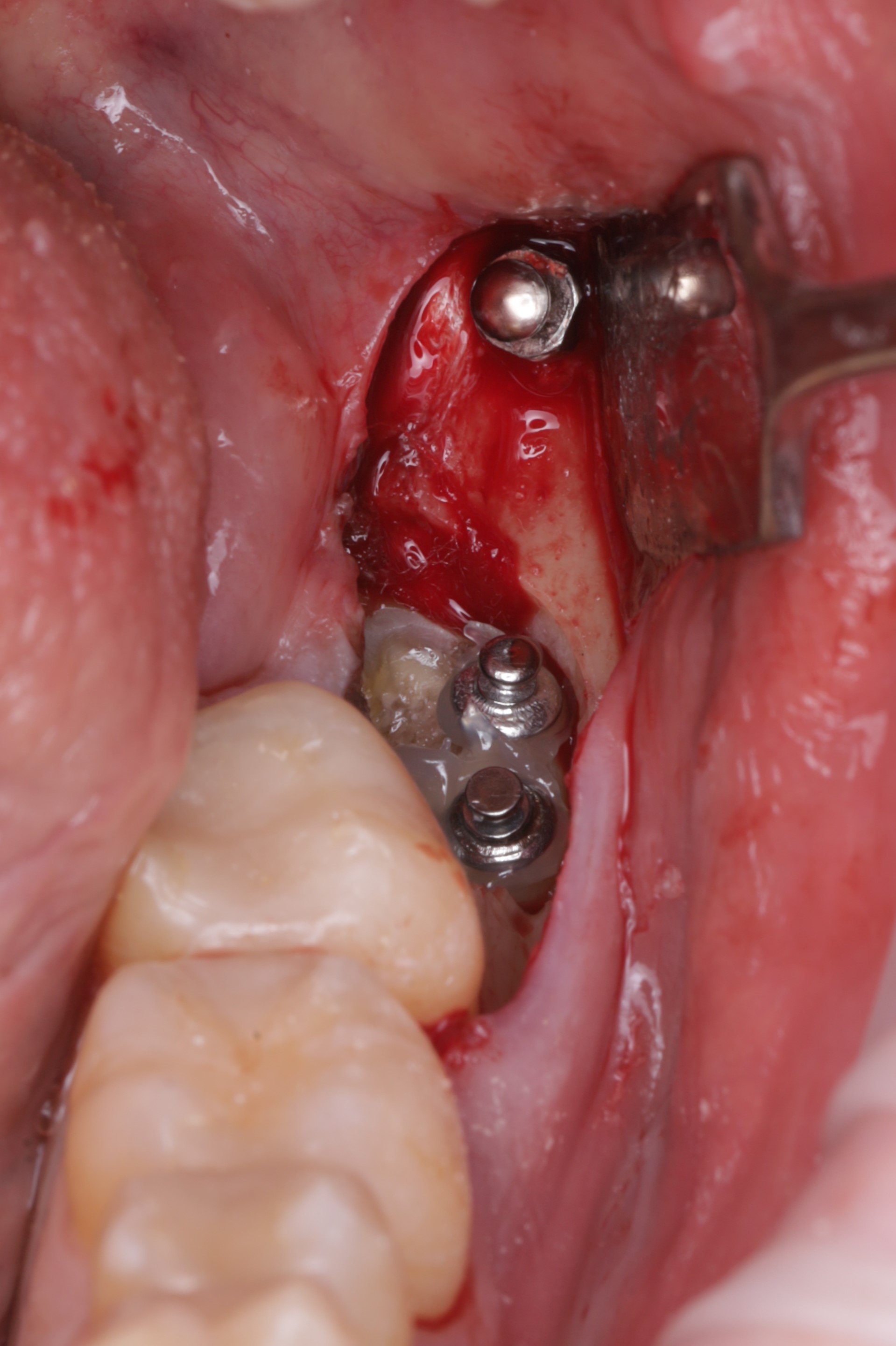 Установлен ортодонтический минивинт и три кнопки 