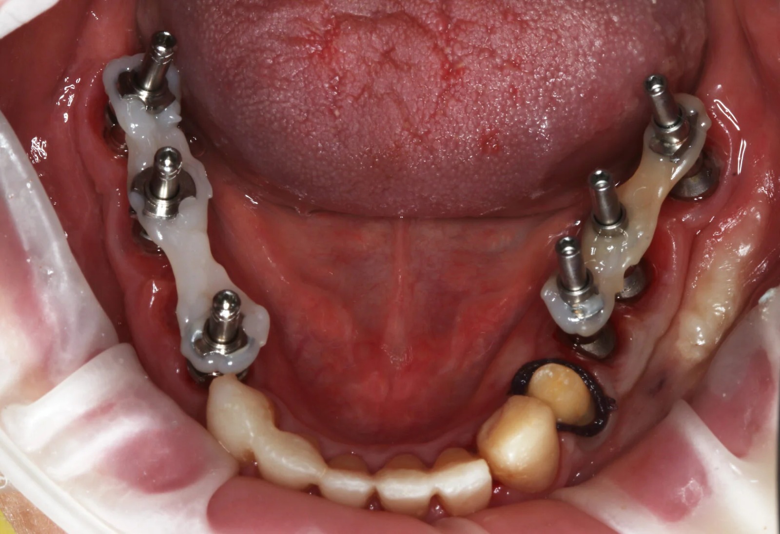«Альтернативная ортопедия. Протезирование на имплантатах»