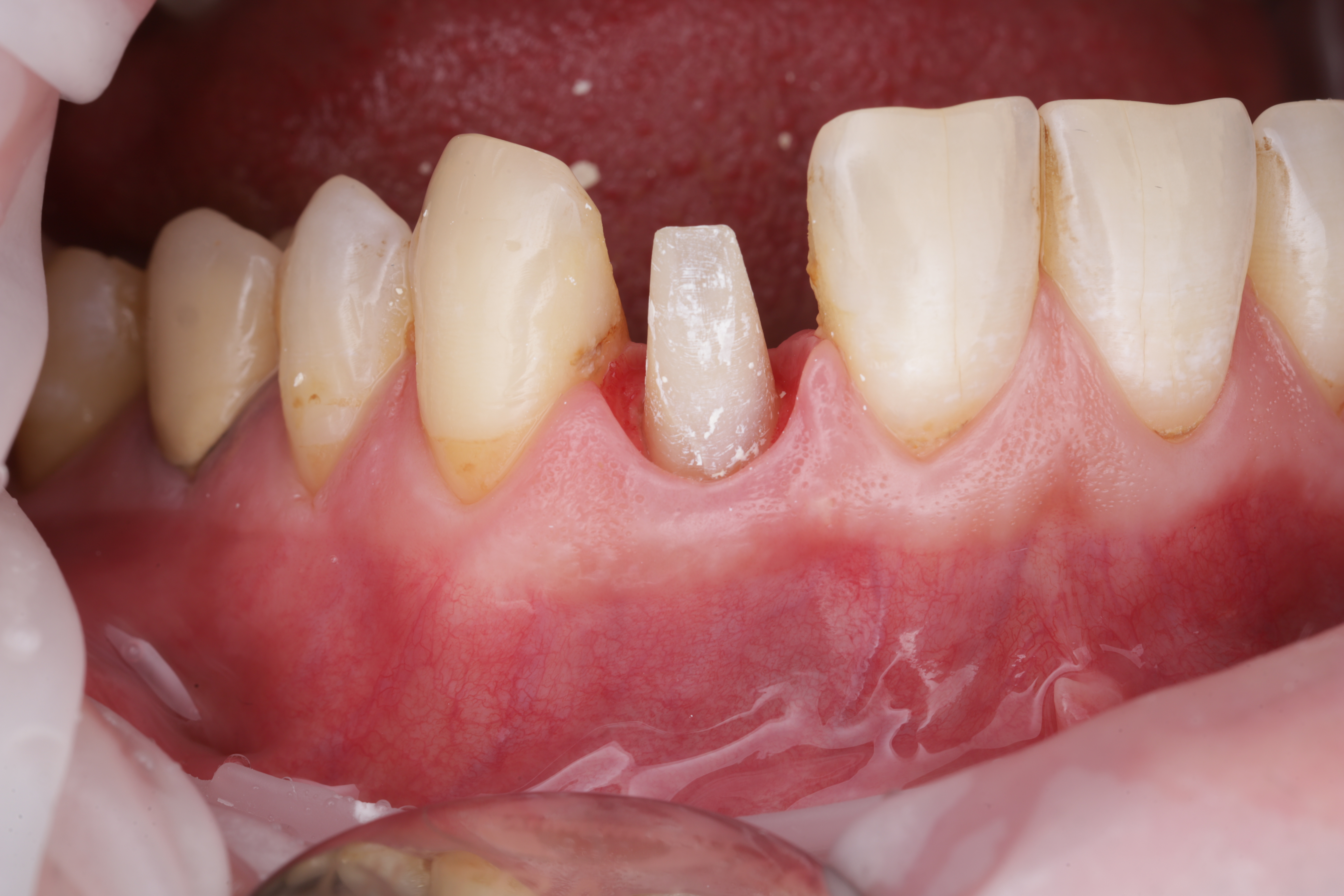 Спустя 4 месяца произведена препаровка зуба под временную и постоянные коронки