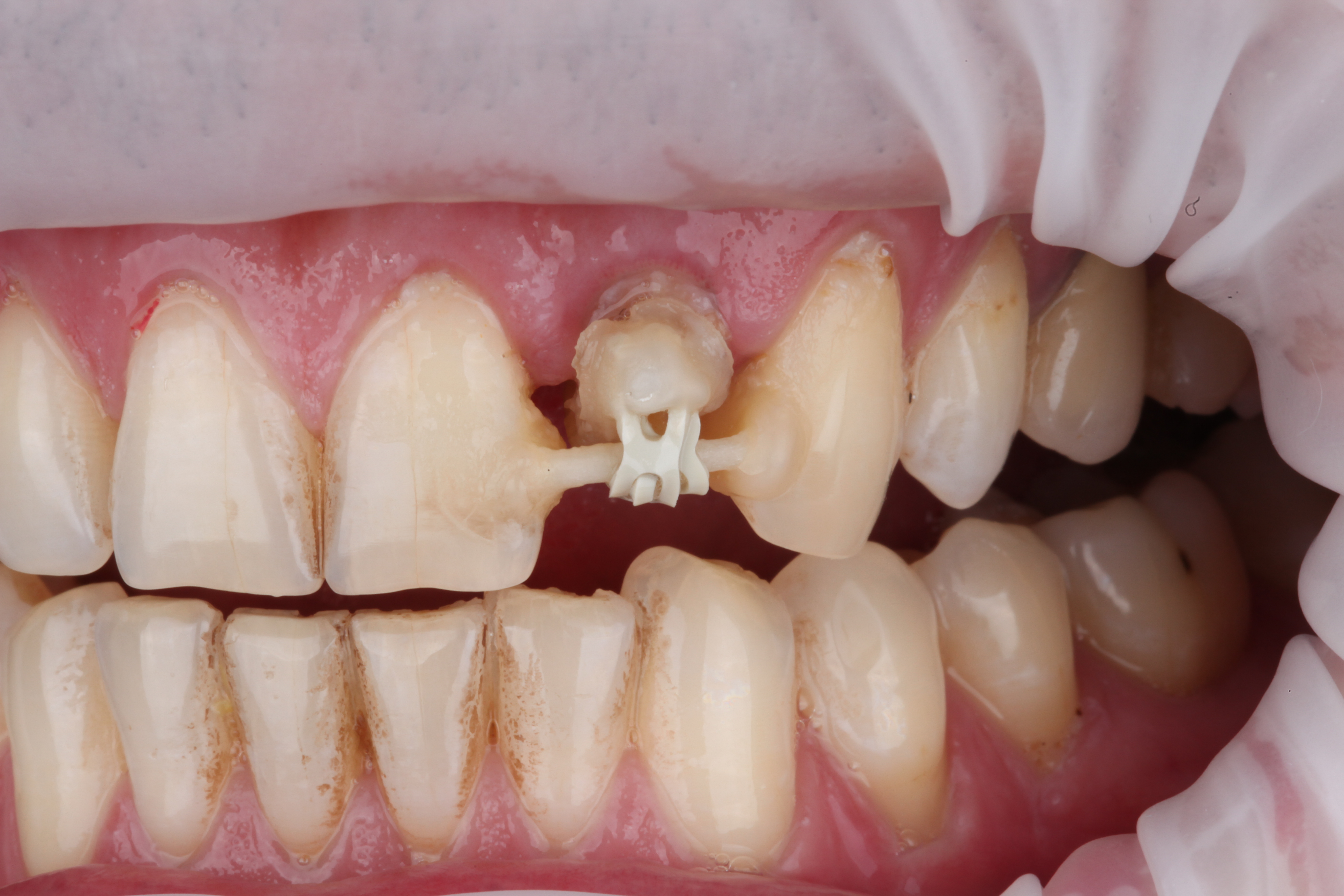 Спустя несколько недель мы видим что корень вытянут на достаточный для восстановления уровень