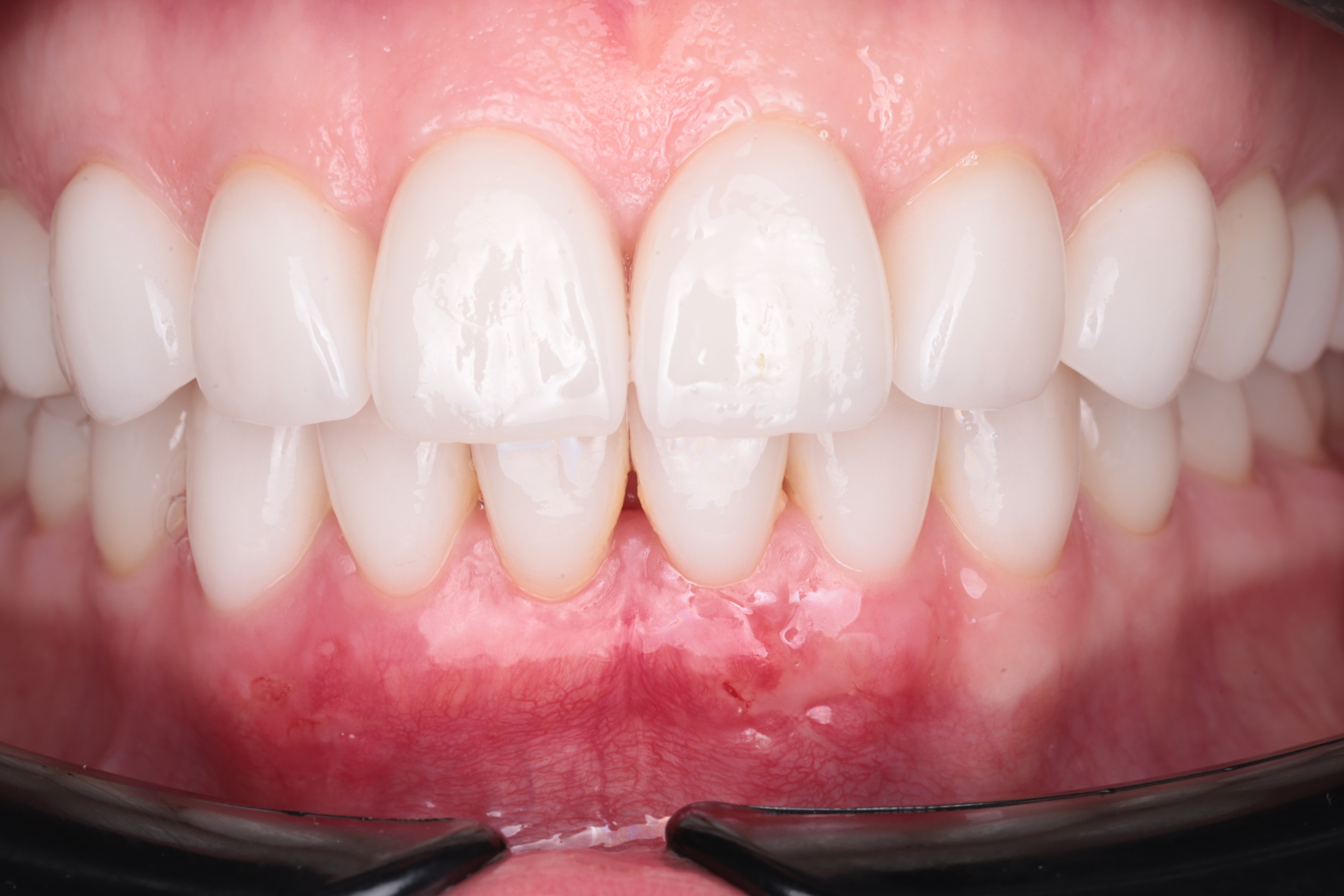 Через 3 недели после операции - видим немного гиперимированную слизистую и слегка  отечную в области проведенной операции