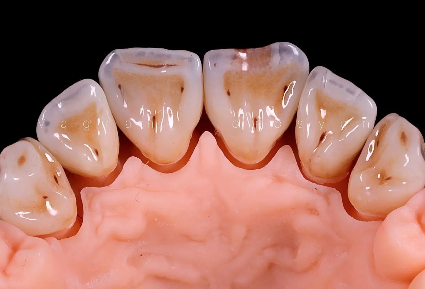 Симметрия формы и цвета. Живая эстетика и индивидуализация в полно анатомических конструкциях из диоксида циркония»