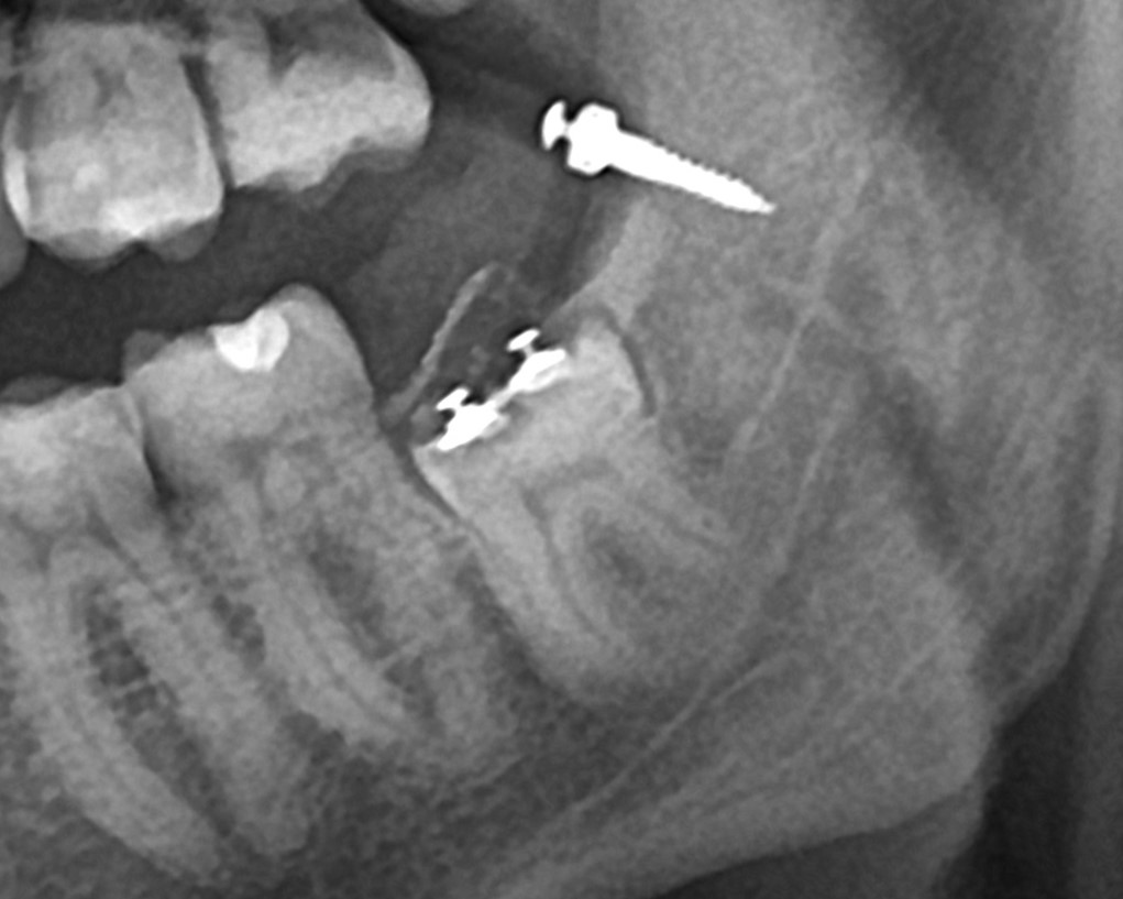 послеоперационная ОПТГ 