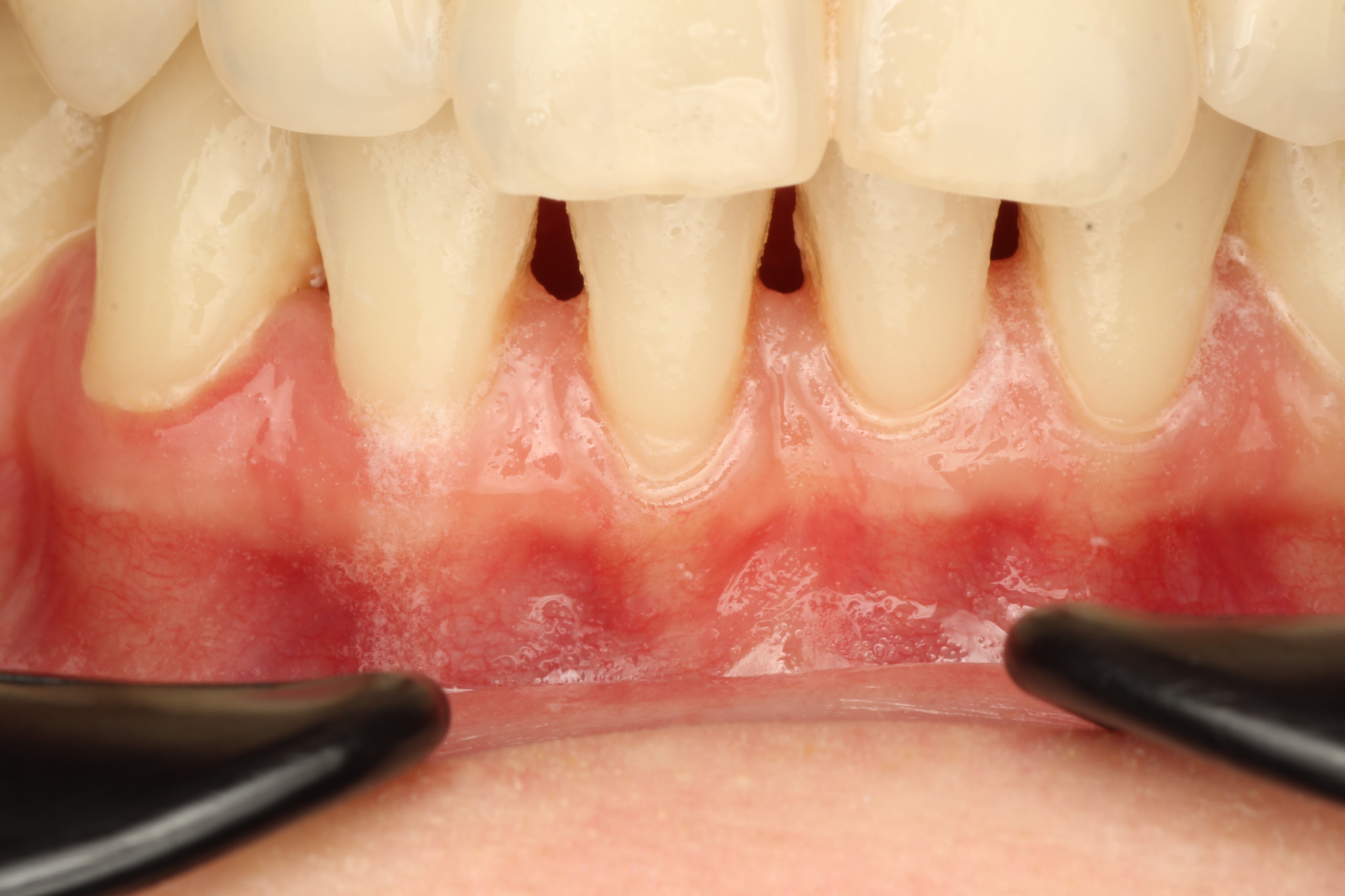 тонкий биотип десны, рецессия 2 мм на зубе 4.1