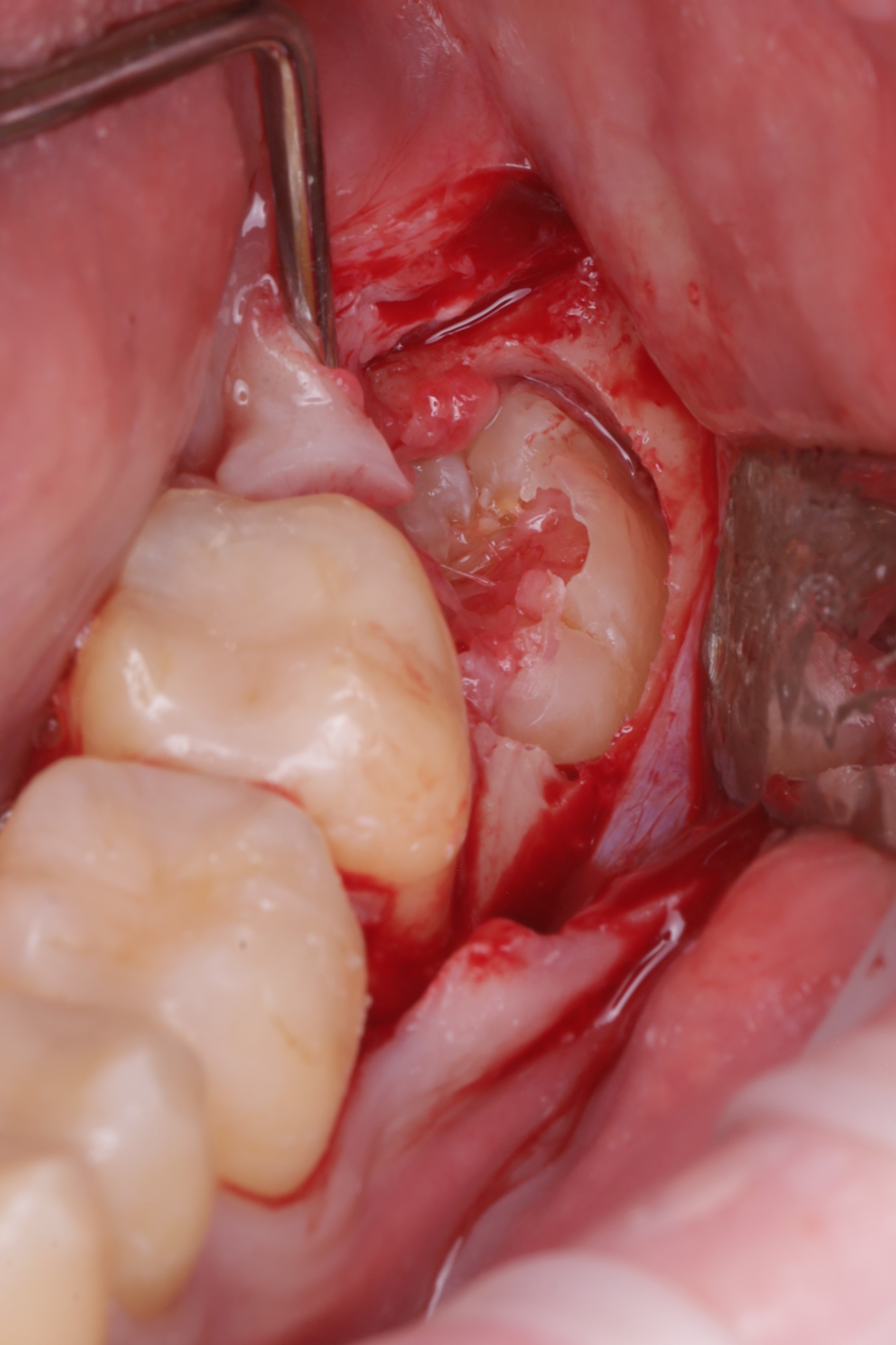 Произведено иссечение тканей коронковой части зуба