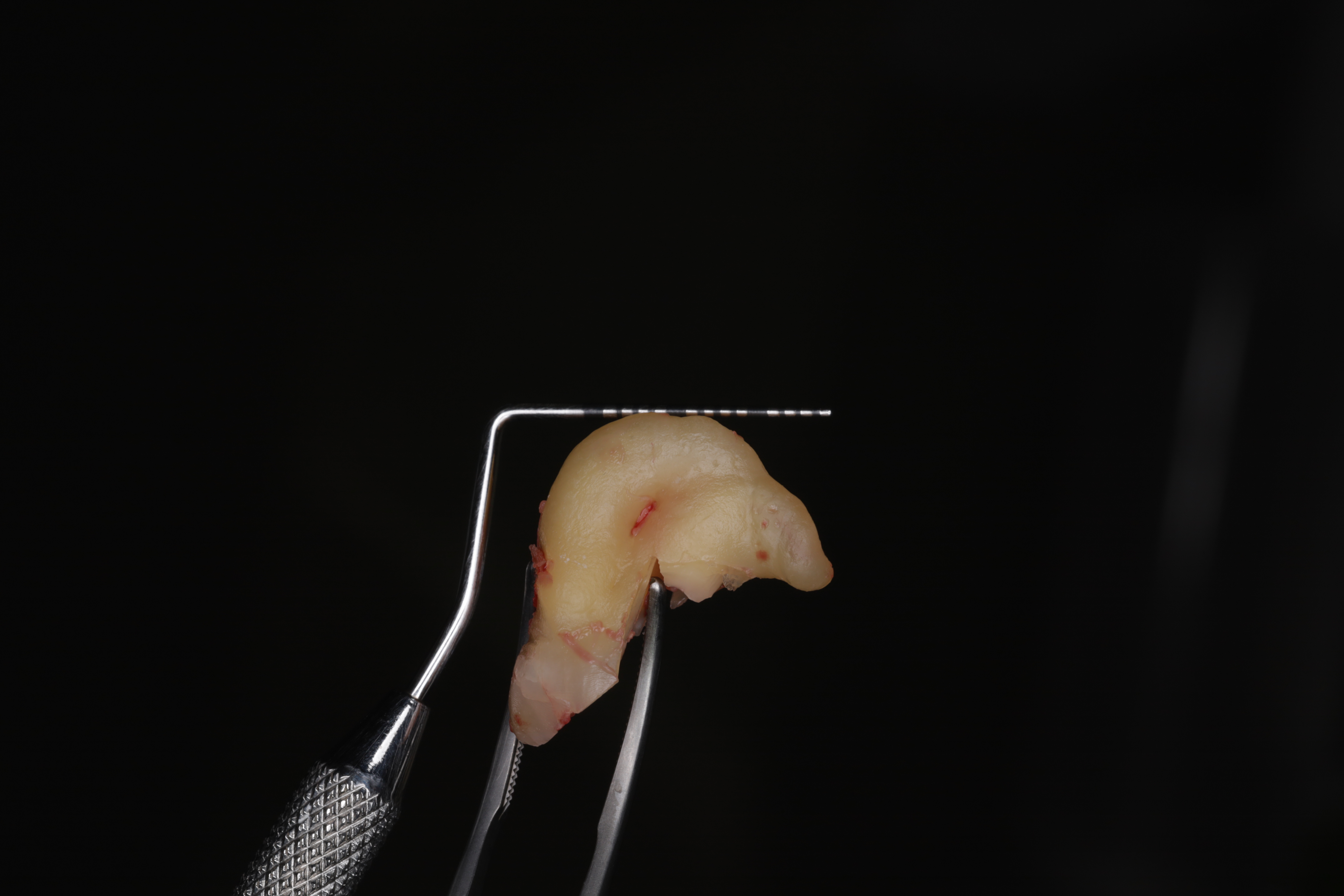 Зуб после удаления с приложенным пародонтальным зондом 