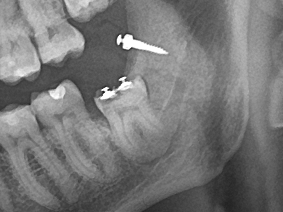 ОПТГ через 7 недель. Уже заметен контур корня в области апекса.