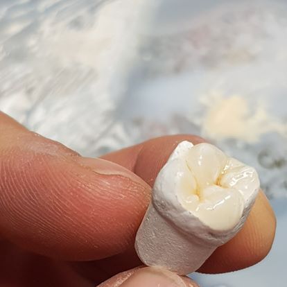 Особенности изготовления ультратонких виниров без препарирования