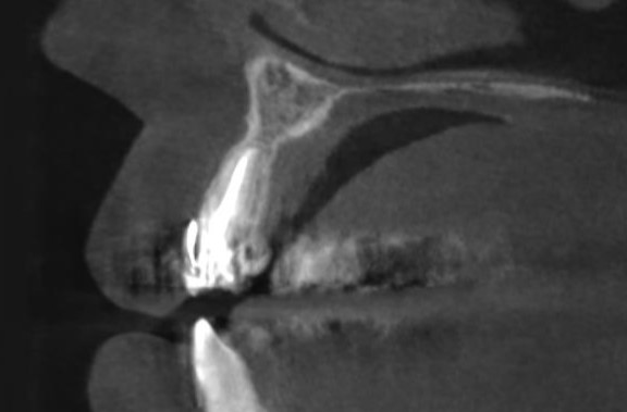 Поперечный срез в области зуба 2.2 - заметно полное закрытие костного дефекта 