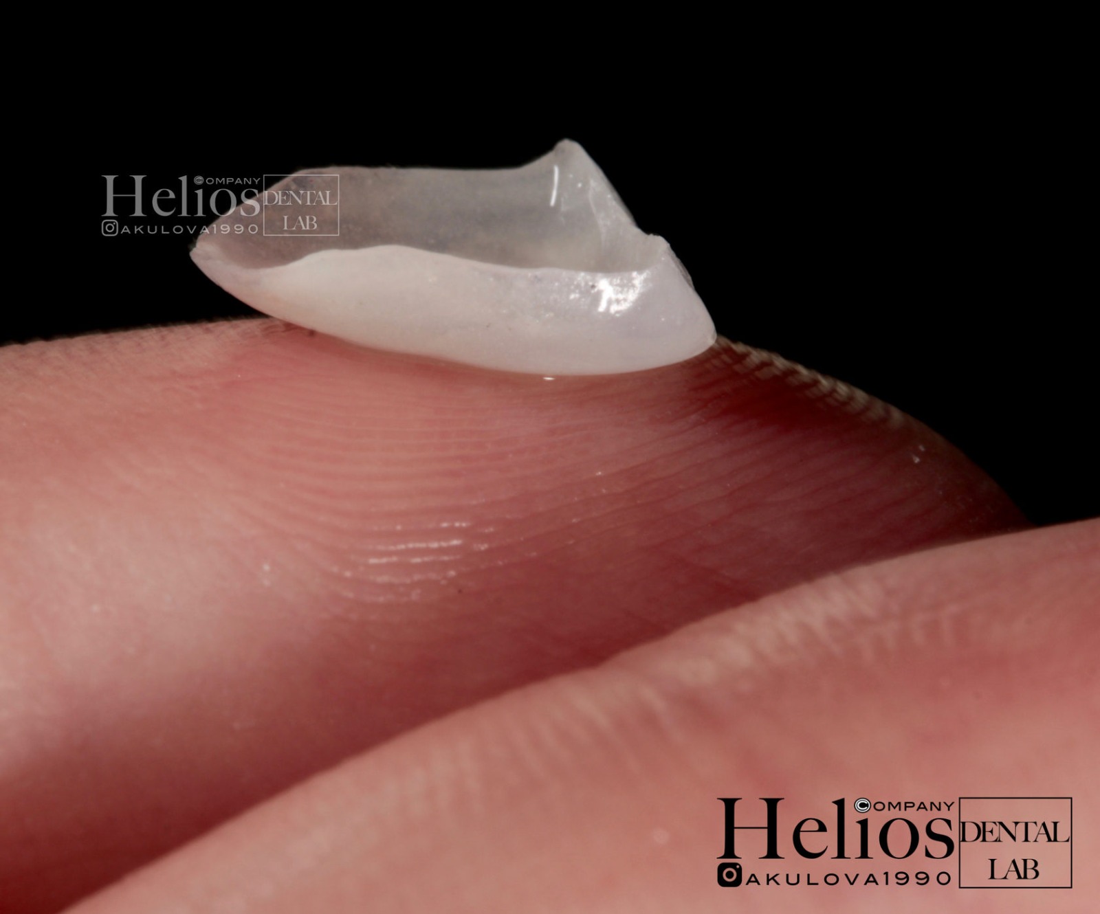 «Создание ультратонких виниров на рефракторе из керамической массы Duceram Kiss + коронка e.max Ceram на основе диоксида циркония на имплантате»