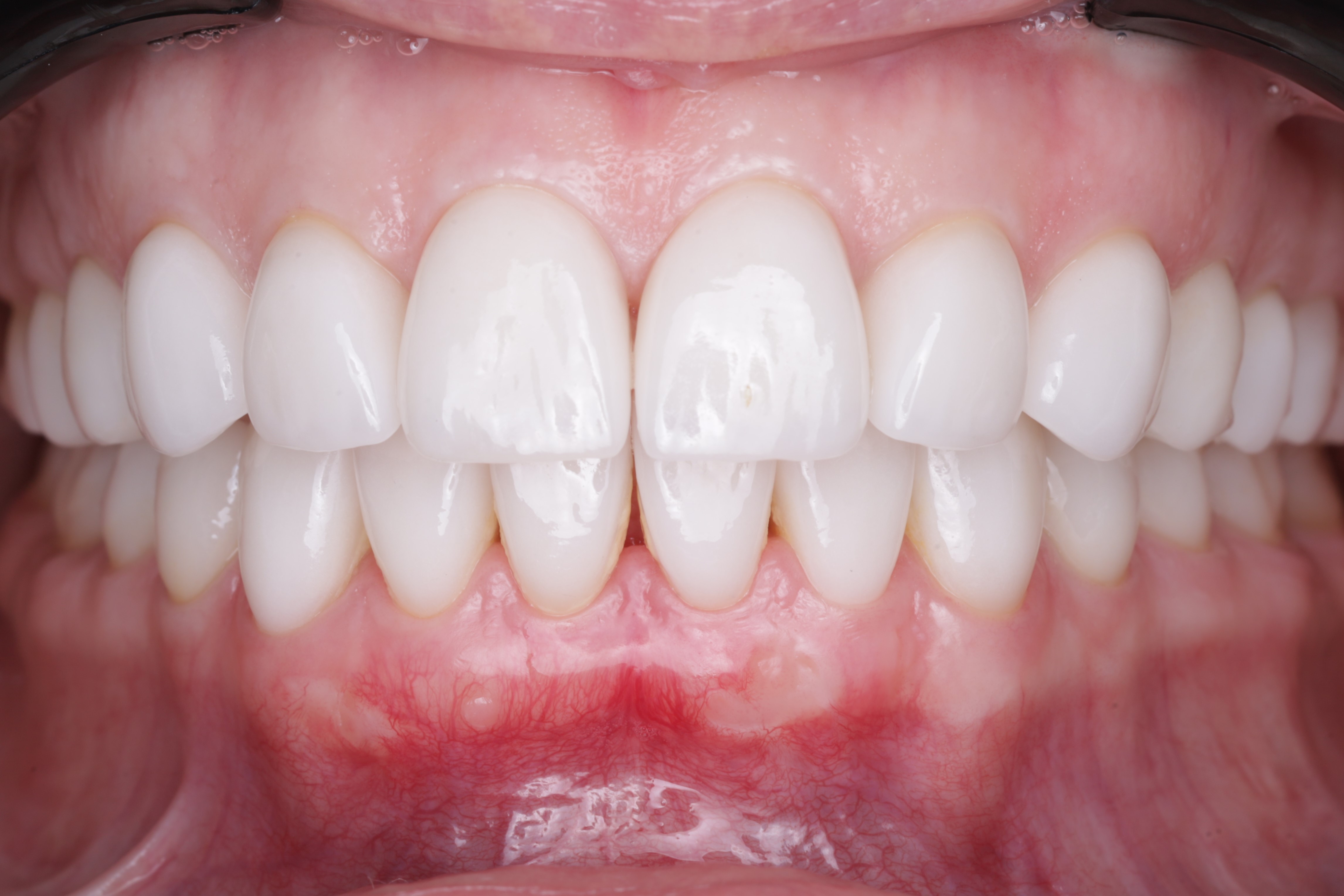 Спустя шесть  месяцев после закрытия рецессий десны. 