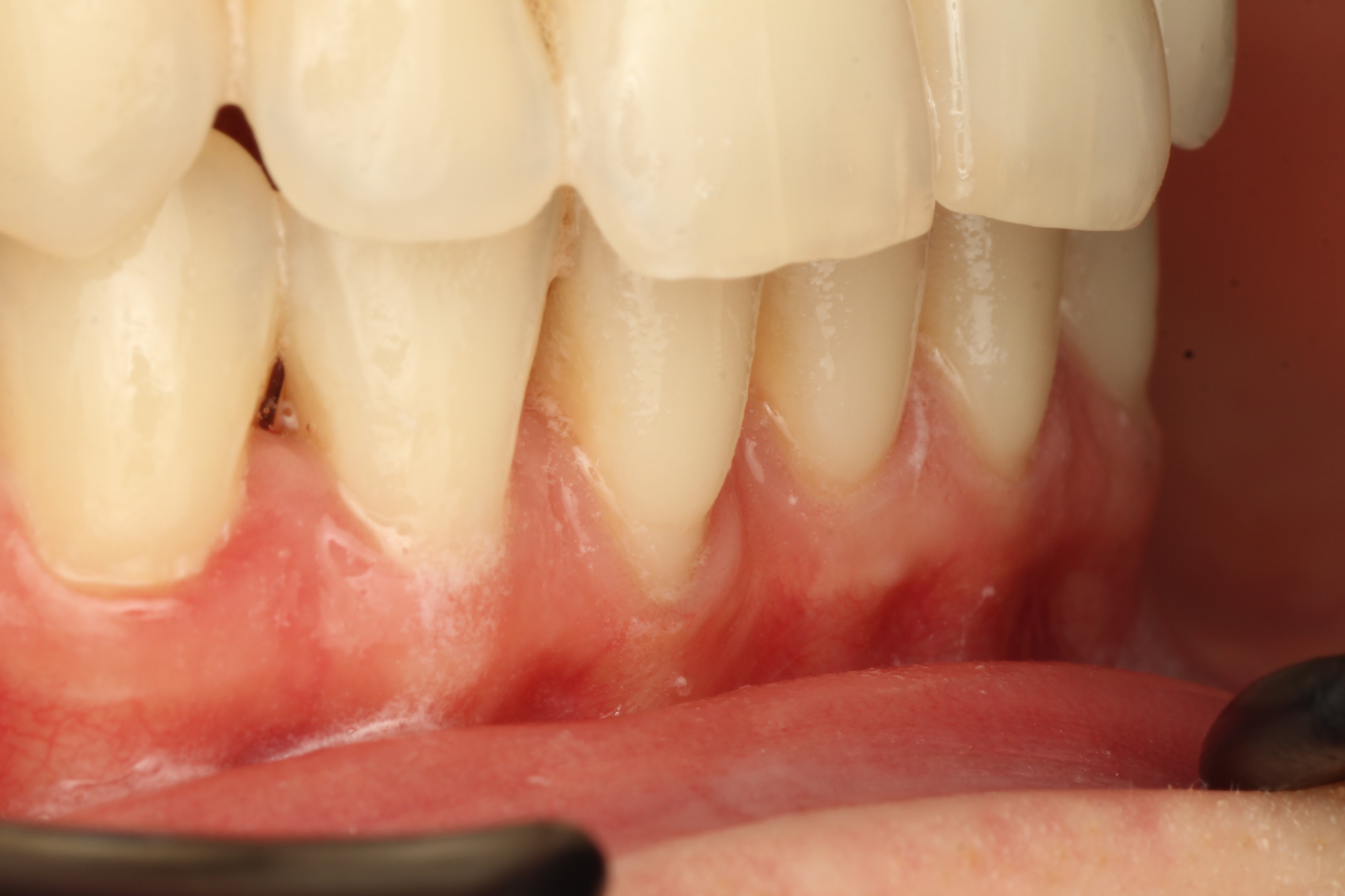 на фотографии в боковой проекции четко видны границы оголенного корня 