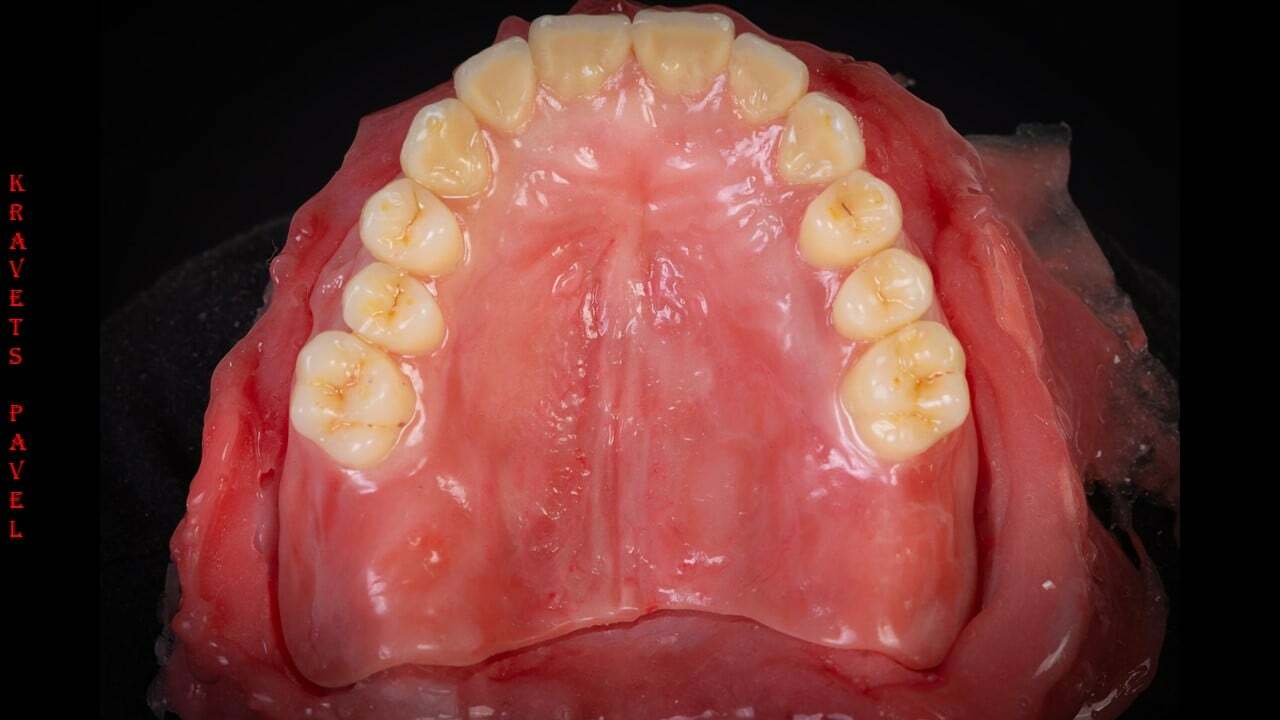 «Конструкции на имплантатах. Винтовая фиксация при тотальном протезировании. Условно-съёмные конструкции и работы на мультиюнитах»