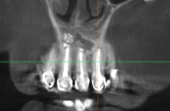 Практически полное закрытие дефекта в области операции 