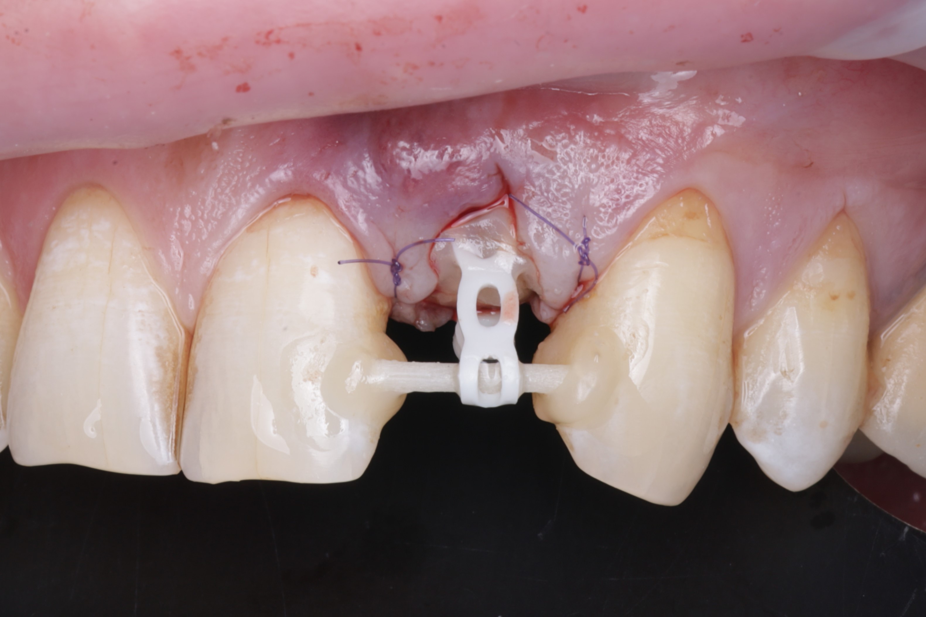 Зафиксирован стекловолоконный штифт и ортодонтическая тяга для вытяжения зуба.