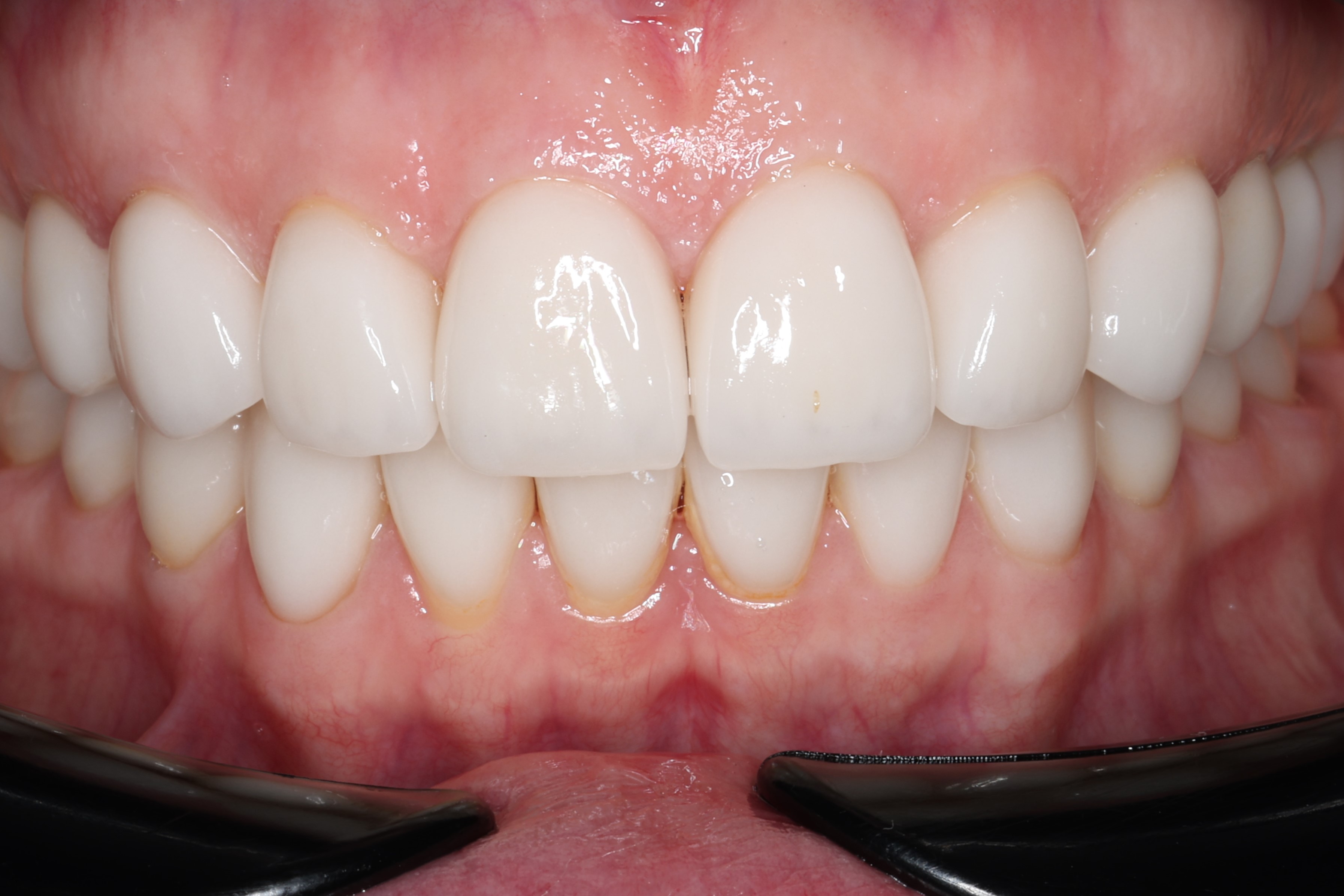 Исходная клиническая картина. Видим рецессии десны на зубах 4.2,4.1,3.1. Неудовлетворительную гигиену и хорошее прилегание ортопедической конструкции. 