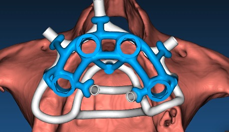 «Разборные хирургические шаблоны в RealGUIDE: поэтапное моделирование накостных, комбинированных, металлических шаблонов и конструкций для немедленной