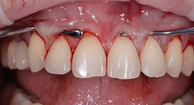 Хирургическое устранение рецессий десны. Восстановление межзубного сосочка. Показания. Методики. Разбор ошибок и осложнений.