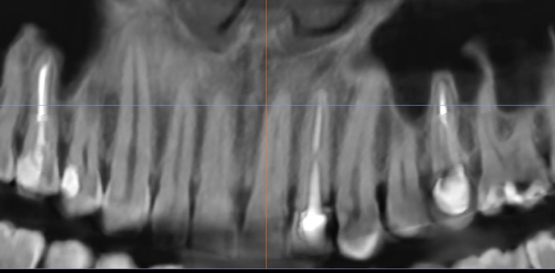 На рентгенологическом снимке видим что ранее в корень зуба был установлена вкладка